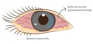 purulent conjunctivitis