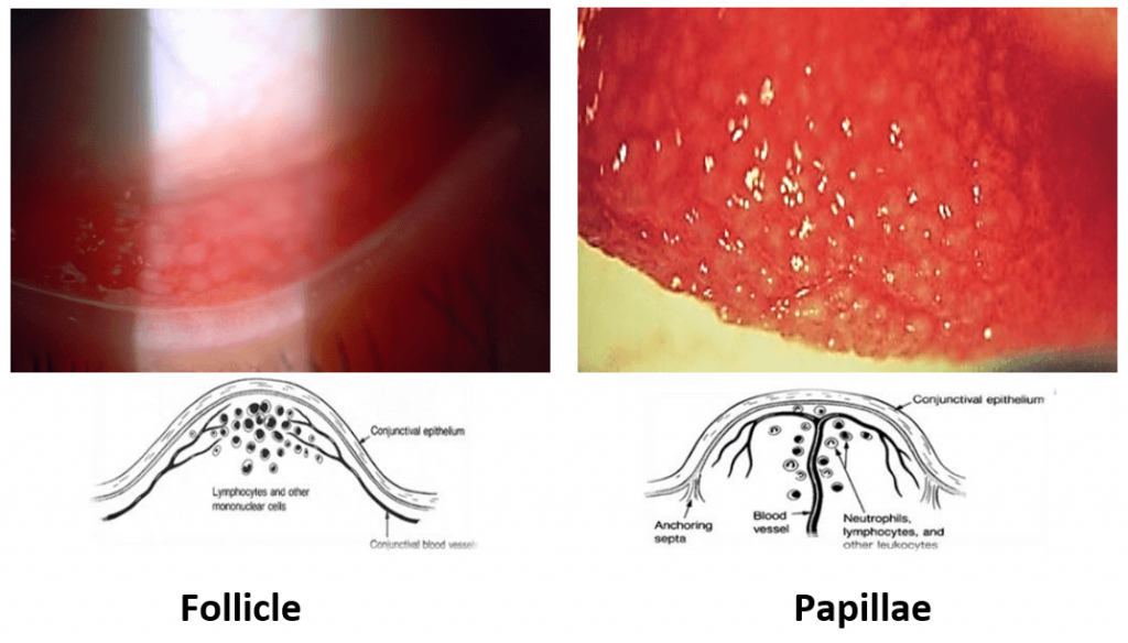 Reaction of conjunctiva lining the inner eyelid