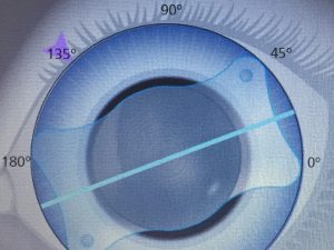 intraocular lens types