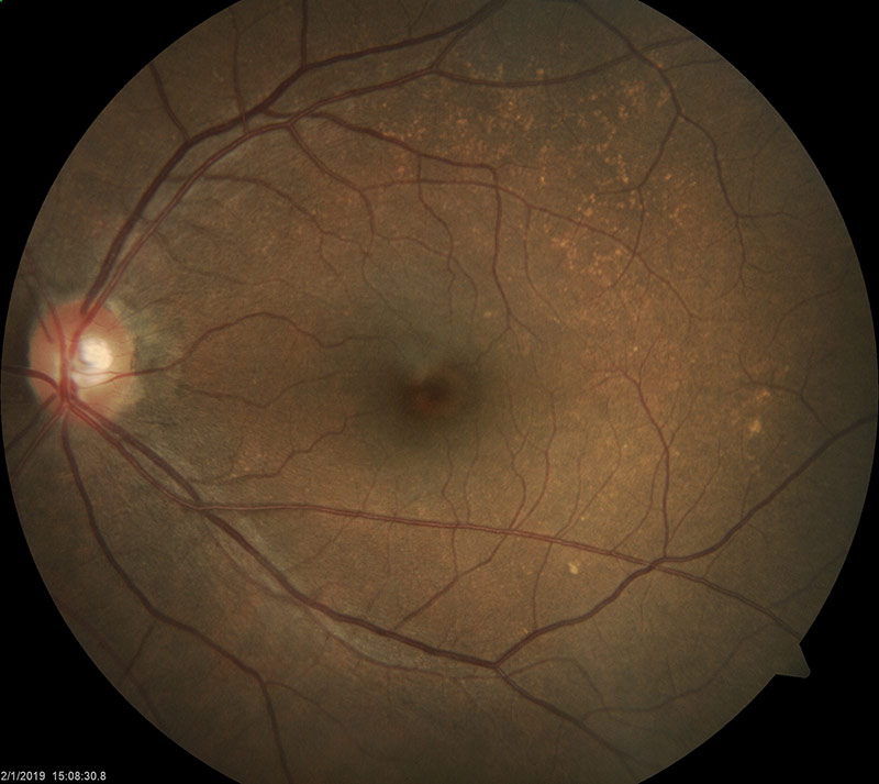 Dry AMD in left eye