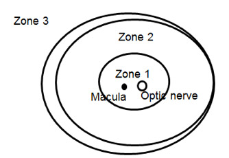 zones of retinopathy of prematurity