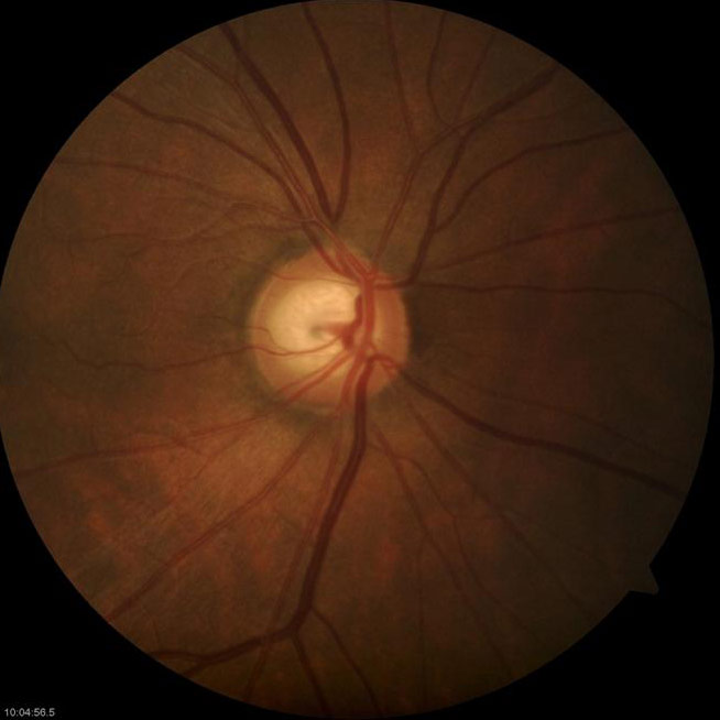 glaucoma in left eye