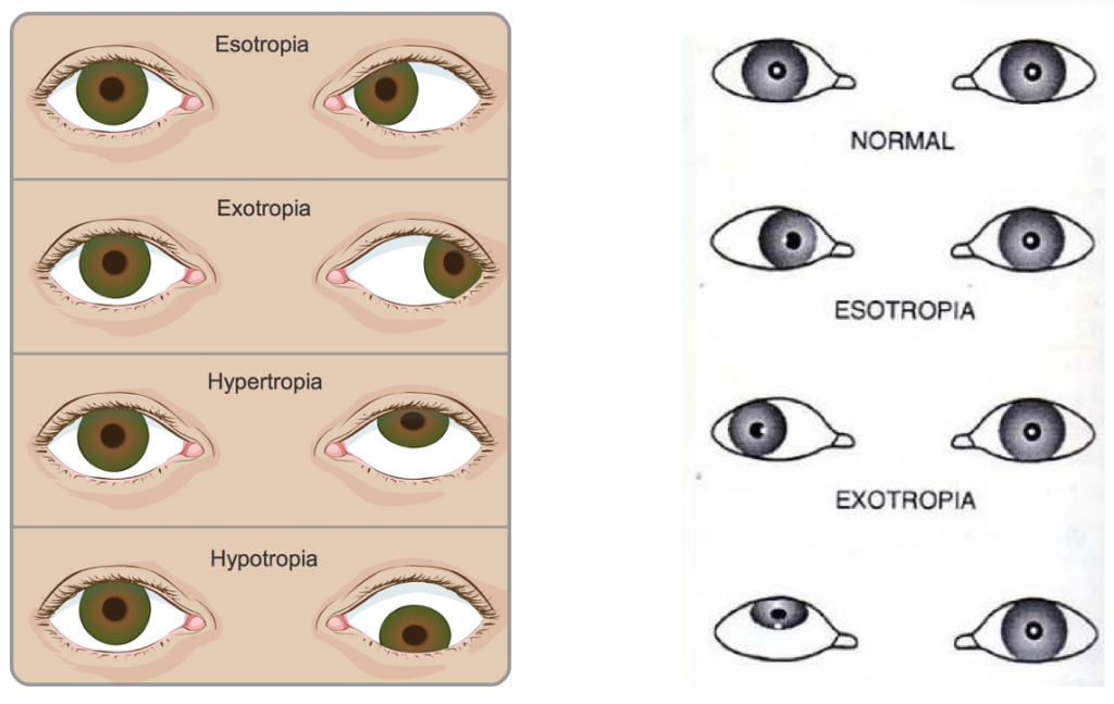 Strabismus Squint Singapore Causes And Treatment Options 