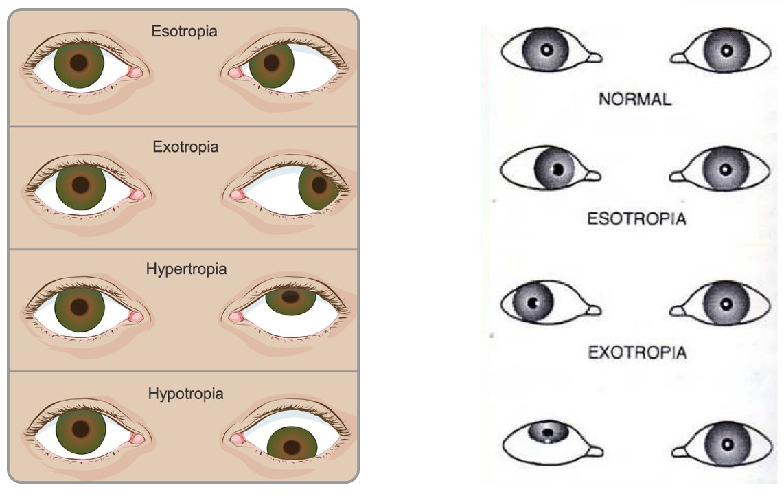 Strabismus Squint Singapore Causes Treatment Options