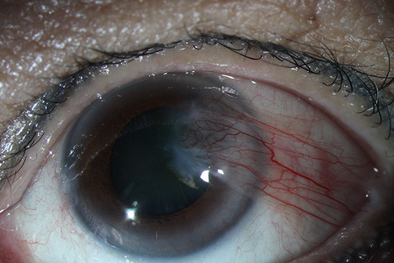 pterygium growth